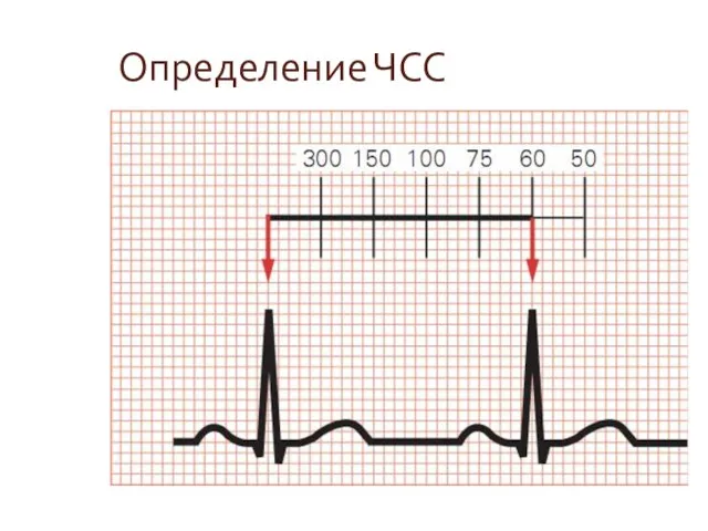 Определение ЧСС