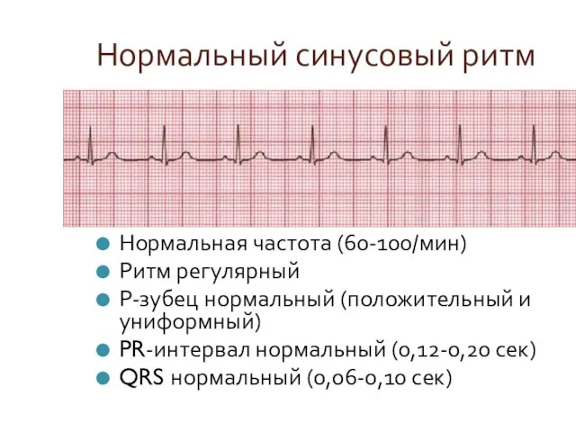 Нормальный синусовый ритм Нормальная частота (60-100/мин) Ритм регулярный Р-зубец нормальный (положительный и