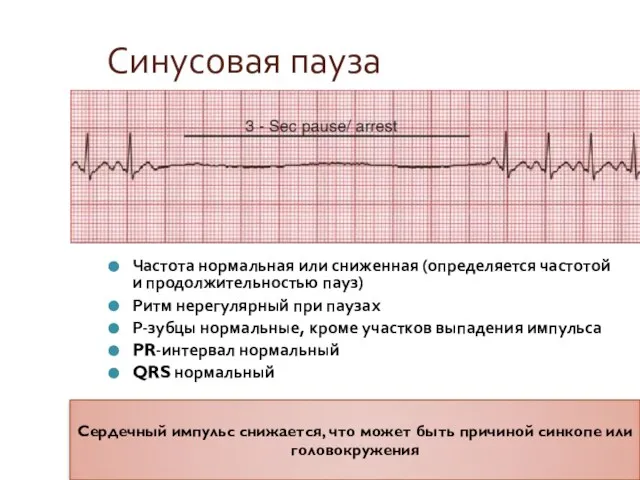 Синусовая пауза Частота нормальная или сниженная (определяется частотой и продолжительностью пауз) Ритм