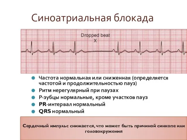 Синоатриальная блокада Частота нормальная или сниженная (определяется частотой и продолжительностью пауз) Ритм