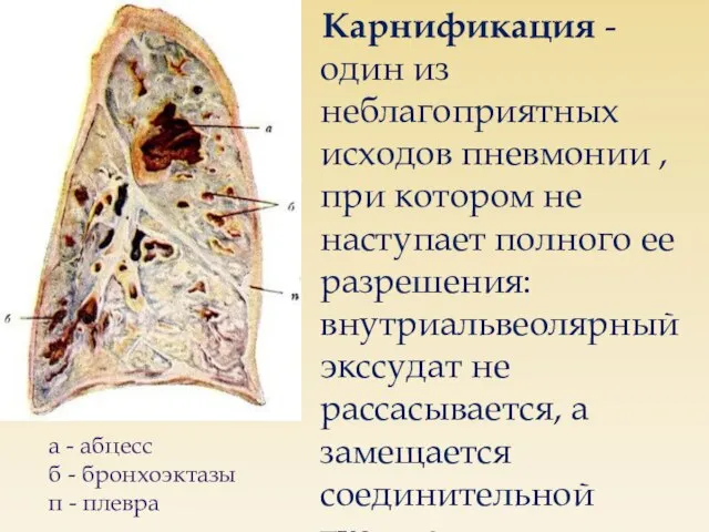 Карнификация - один из неблагоприятных исходов пневмонии , при котором не наступает