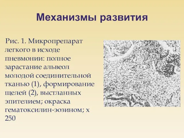 Механизмы развития Рис. 1. Микропрепарат легкого в исходе пневмонии: полное зарастание альвеол
