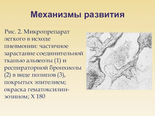 Механизмы развития Рис. 2. Микропрепарат легкого в исходе пневмонии: частичное зарастание соединительной