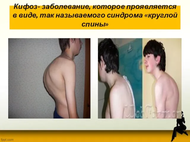 Кифоз- заболевание, которое проявляется в виде, так называемого синдрома «круглой спины»