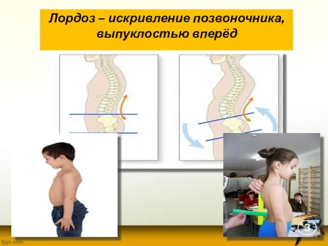 Лордоз – искривление позвоночника, выпуклостью вперёд