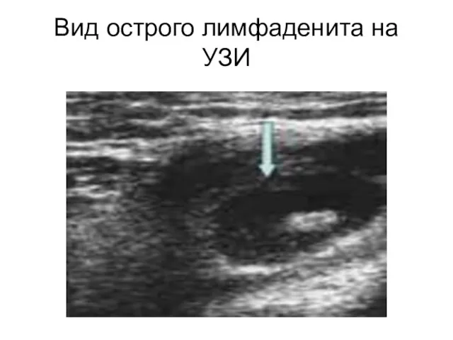 Вид острого лимфаденита на УЗИ