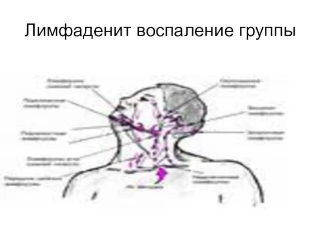 Лимфаденит воспаление группы