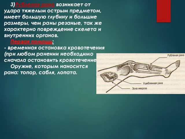 3)Рубленая рана возникает от удара тяжелым острым предметом, имеет большую глубину и