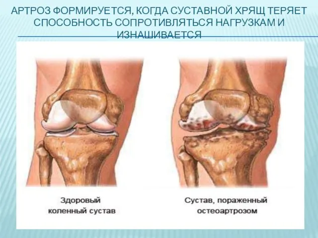 АРТРОЗ ФОРМИРУЕТСЯ, КОГДА СУСТАВНОЙ ХРЯЩ ТЕРЯЕТ СПОСОБНОСТЬ СОПРОТИВЛЯТЬСЯ НАГРУЗКАМ И ИЗНАШИВАЕТСЯ