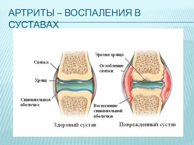 АРТРИТЫ – ВОСПАЛЕНИЯ В СУСТАВАХ