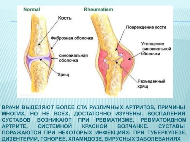 ВРАЧИ ВЫДЕЛЯЮТ БОЛЕЕ СТА РАЗЛИЧНЫХ АРТРИТОВ, ПРИЧИНЫ МНОГИХ, НО НЕ ВСЕХ, ДОСТАТОЧНО