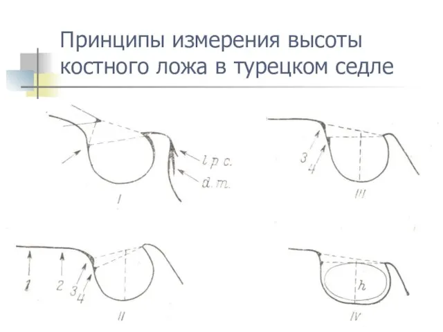 Принципы измерения высоты костного ложа в турецком седле