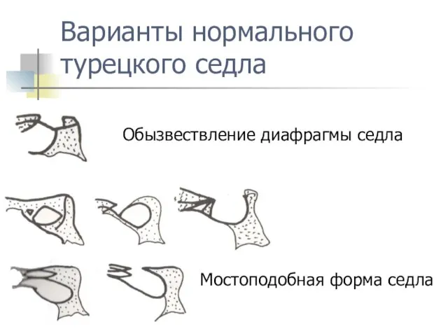 Варианты нормального турецкого седла Обызвествление диафрагмы седла Мостоподобная форма седла