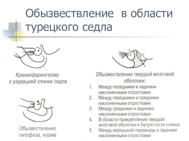 Обызвествление в области турецкого седла