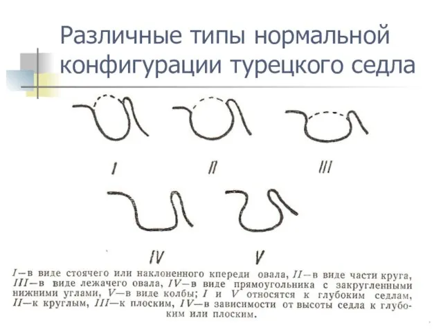 Различные типы нормальной конфигурации турецкого седла