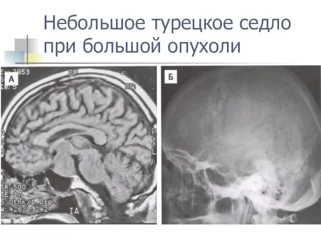 Небольшое турецкое седло при большой опухоли