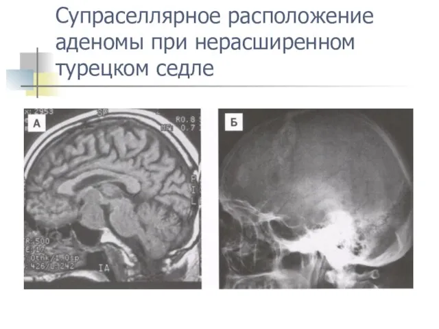 Супраселлярное расположение аденомы при нерасширенном турецком седле
