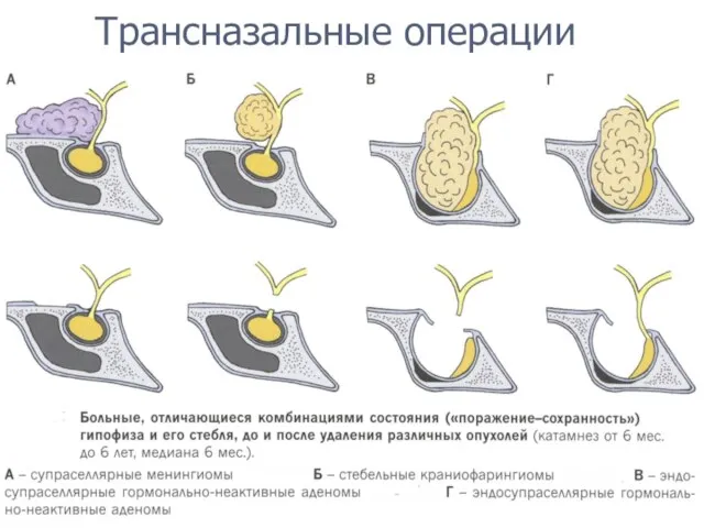 Трансназальные операции