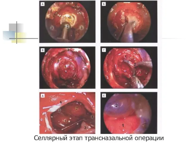Селлярный этап трансназальной операции