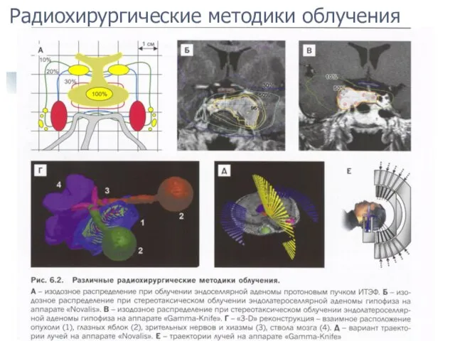 Радиохирургические методики облучения