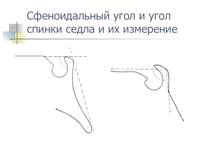 Сфеноидальный угол и угол спинки седла и их измерение