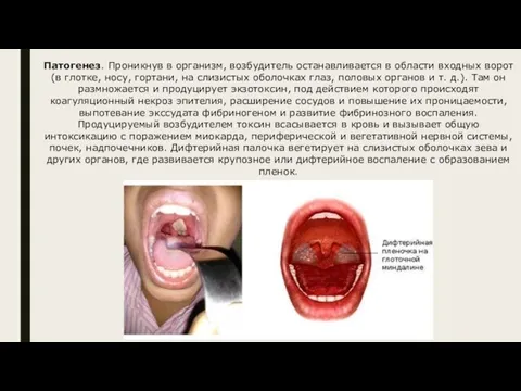 Патогенез. Проникнув в организм, возбудитель останавливается в области входных ворот (в глотке,