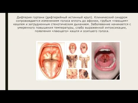 Дифтерия гортани (дифтерийный истинный круп). Клинический синдром сопровождается изменением голоса вплоть до