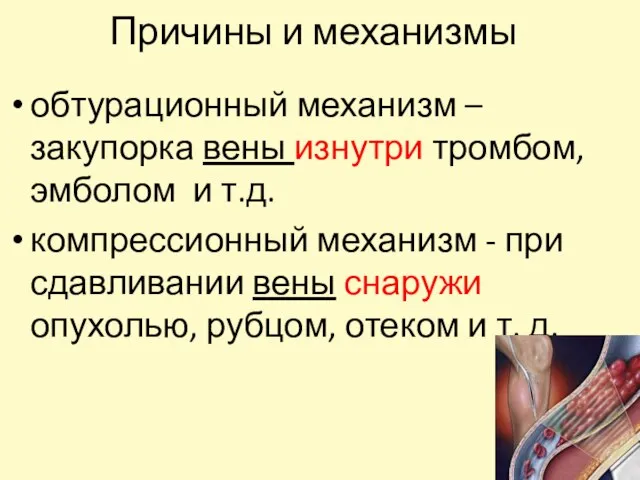 обтурационный механизм –закупорка вены изнутри тромбом, эмболом и т.д. компрессионный механизм -