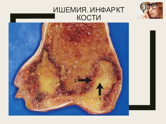 ИШЕМИЯ. ИНФАРКТ КОСТИ