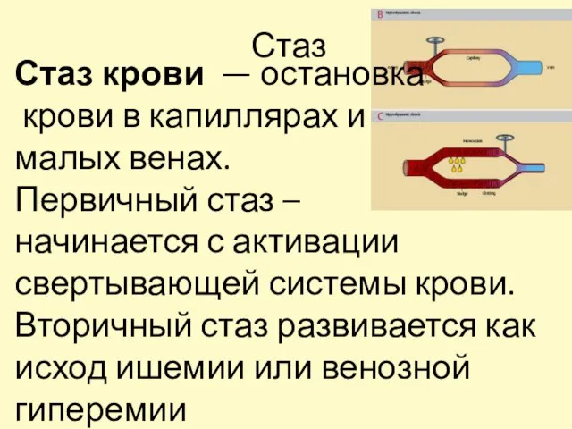 Стаз Стаз крови — остановка крови в капиллярах и малых венах. Первичный