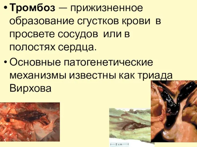 Тромбоз — прижизненное образование сгустков крови в просвете сосудов или в полостях