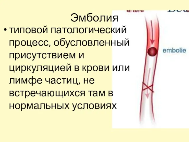 Эмболия типовой патологический процесс, обусловленный присутствием и циркуляцией в крови или лимфе