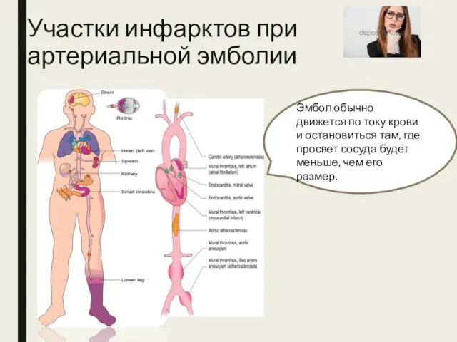 Участки инфарктов при артериальной эмболии Эмбол обычно движется по току крови и