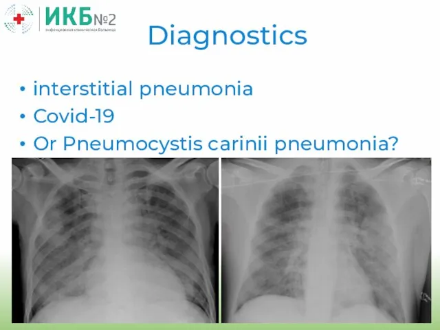 interstitial pneumonia Covid-19 Or Pneumocystis carinii pneumonia? Diagnostics