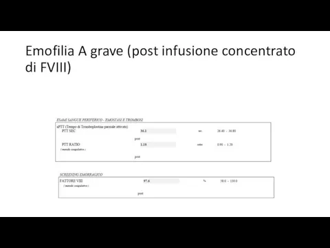 Emofilia A grave (post infusione concentrato di FVIII)