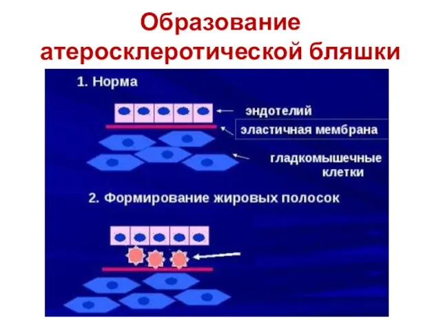 Образование атеросклеротической бляшки