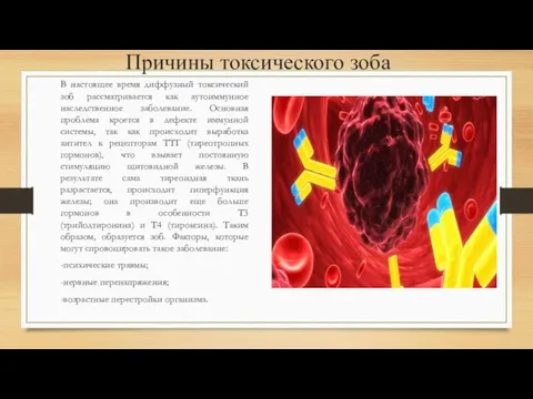 Причины токсического зоба В настоящее время диффузный токсический зоб рассматривается как аутоиммунное