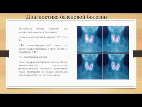 Диагностика базедовой болезни Визуальный осмотр пациента для составления клинической картины; Сдача анализов