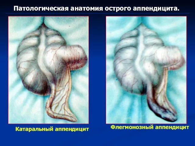 Патологическая анатомия острого аппендицита. Катаральный аппендицит Флегмонозный аппендицит