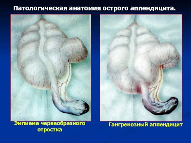 Патологическая анатомия острого аппендицита. Эмпиема червеобразного отростка Гангренозный аппендицит