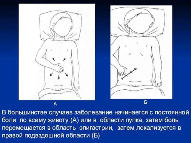 В большинстве случаев заболевание начинается с постоянной боли по всему животу (А)