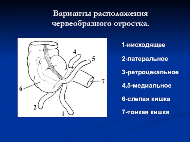 Варианты расположения червеобразного отростка. 1-нисходящее 2-латеральное 3-ретроцекальное 4,5-медиальное 6-слепая кишка 7-тонкая кишка