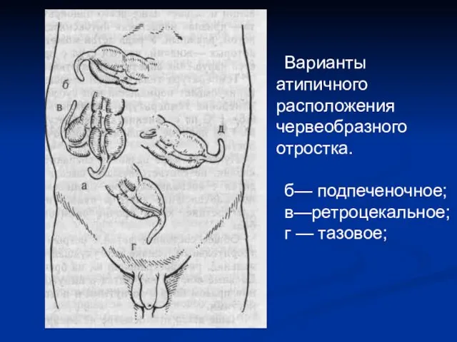 Варианты атипичного расположения черве­образного отростка. б— подпеченочное; в—ретроцекальное; г — тазовое;