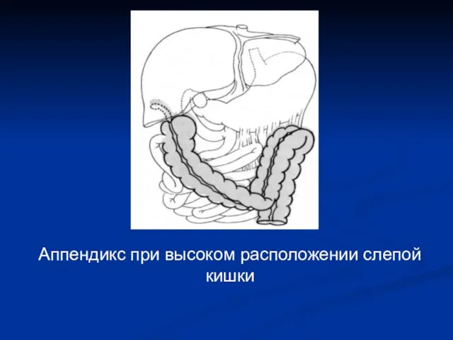 Аппендикс при высоком расположении слепой кишки