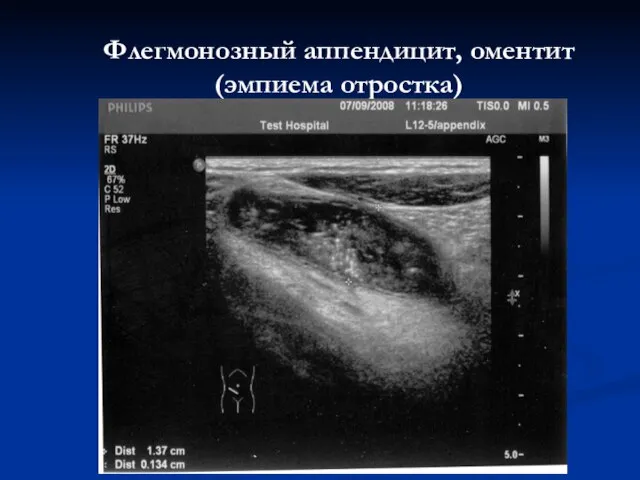 Флегмонозный аппендицит, оментит (эмпиема отростка)