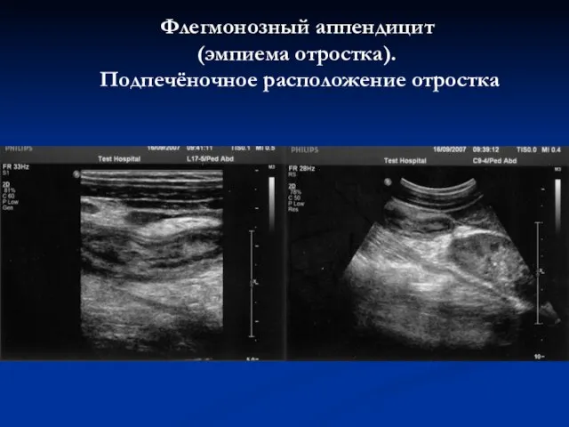 Флегмонозный аппендицит (эмпиема отростка). Подпечёночное расположение отростка