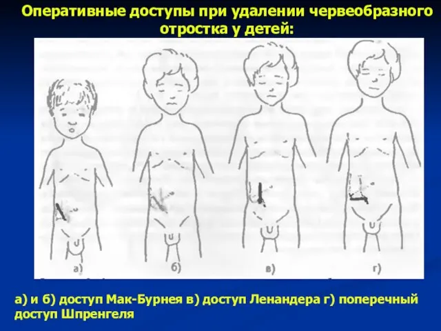 Оперативные доступы при удалении червеобразного отростка у детей: а) и б) доступ