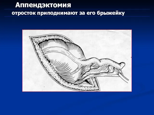 Аппендэктомия отросток приподнимают за его брыжейку