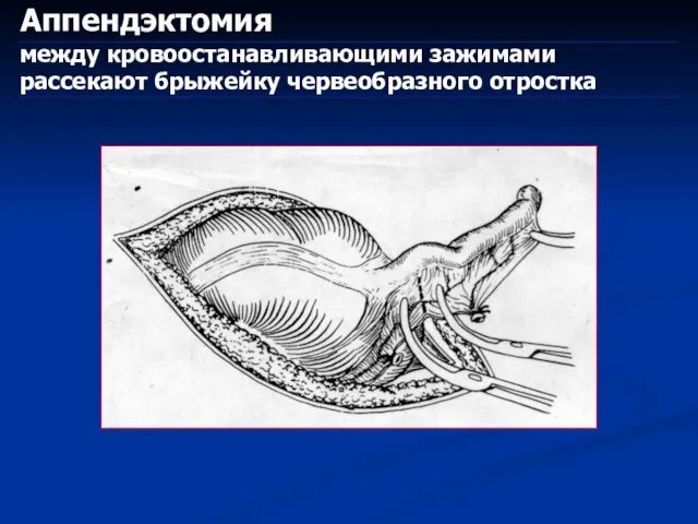 Аппендэктомия между кровоостанавливающими зажимами рассекают брыжейку червеобразного отростка