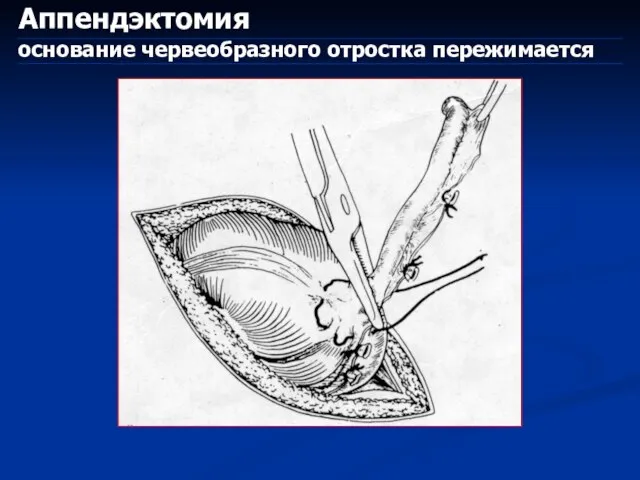 Аппендэктомия основание червеобразного отростка пережимается